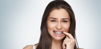 L'apparecchio denti si può mettere anche da adulti