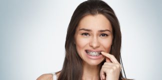 L’apparecchio denti si può mettere anche da adulti L'apparecchio denti si può mettere anche da adulti