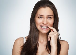 L'apparecchio denti si può mettere anche da adulti